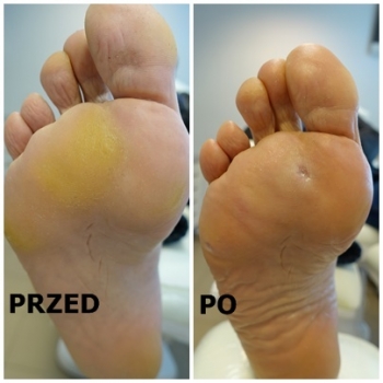 Zabieg pedicure leczniczy