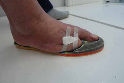 Protezowa wkładka do buta uzupełniająca palce