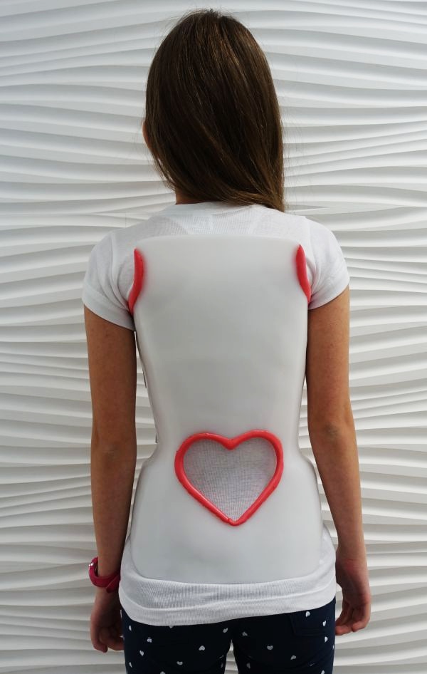 Gorsety ekstensyjne - leczenie hiperkyfoz, choroby Scheuermanna