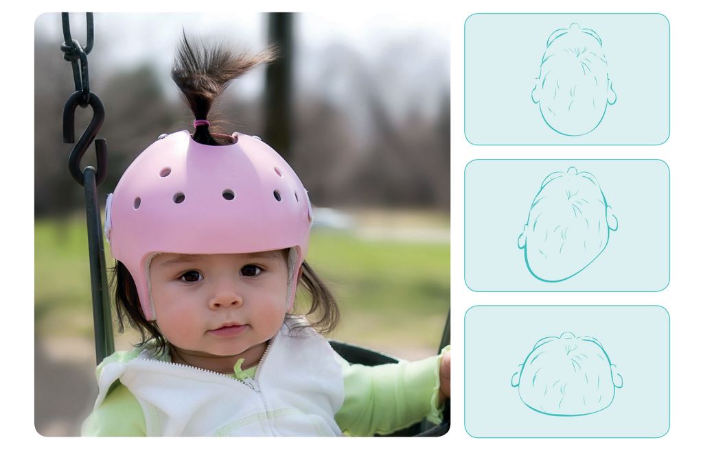 Ortezy głowy - terapia kaskowa